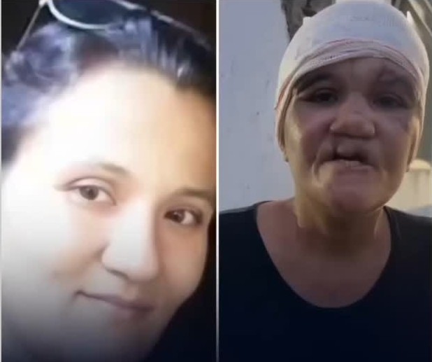 Sobrevivente de  tentativa brutal de feminicídio