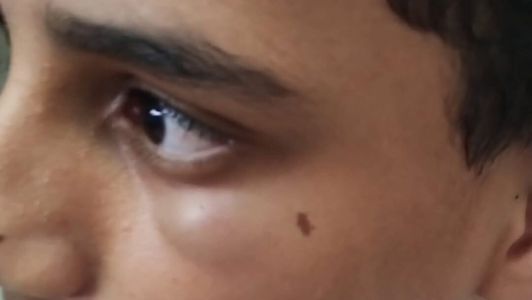 Pai denuncia agressão em escola de Arcoverde